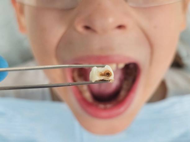 Best Emergency Dental Care for Broken or Chipped Teeth in Wright Patterson Af, OH