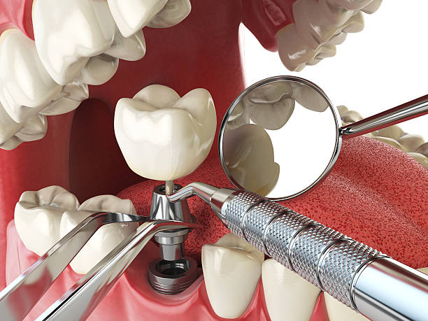 Best Emergency Dental Care for Broken or Chipped Teeth in Wright Patterson Af, OH
